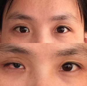 靓目义眼成功案例