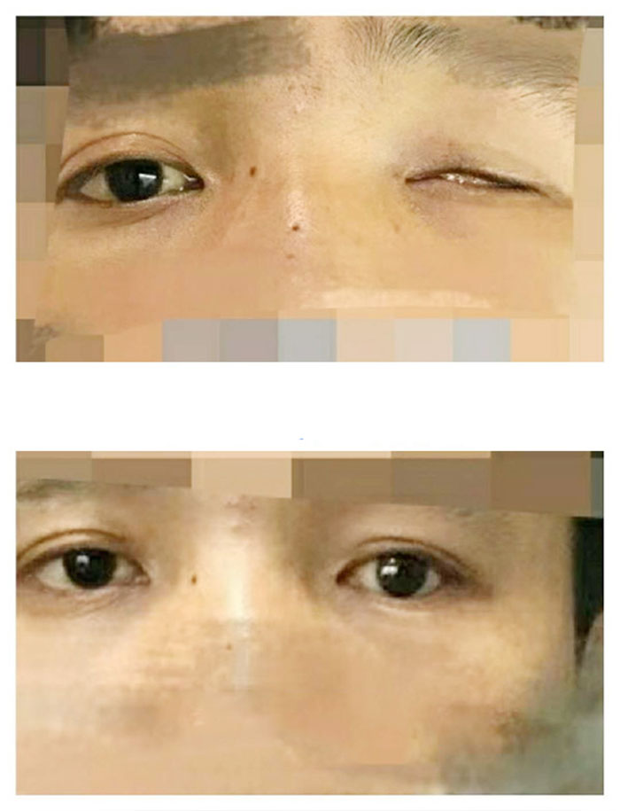 靓目义眼成功案例